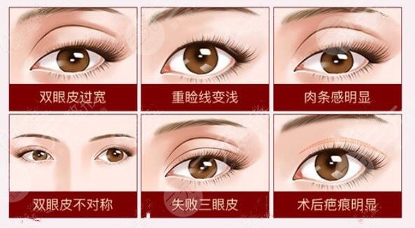 北京空军总医院整形科双眼皮修复案例