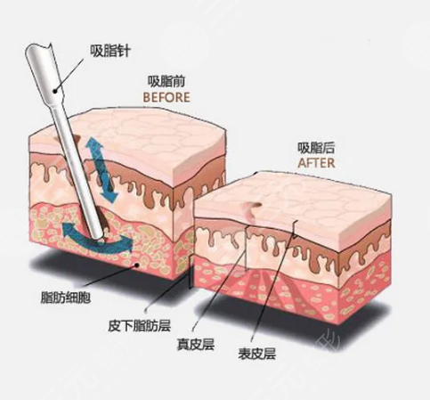 影响抽脂手术价格的因素有哪些?