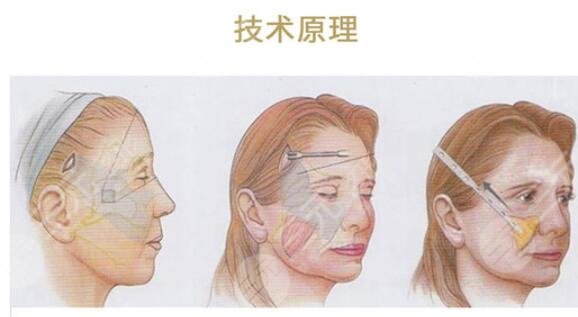 上海九院拉皮除皱案例分享