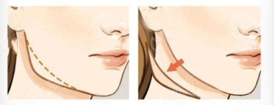 八大处整形医院正颌面部整形案例