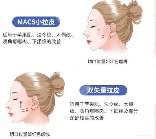 上海九院金云波除皱抗衰案例反馈：