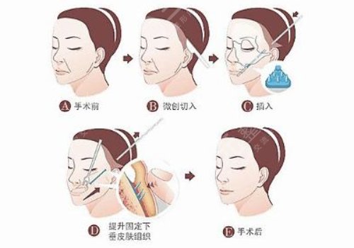八大处拉皮项目科普：