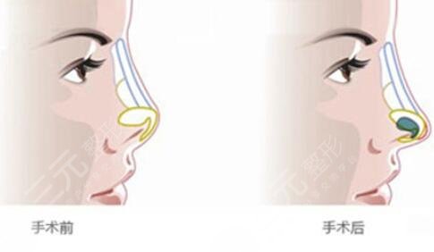 上海九院鼻部整形案例