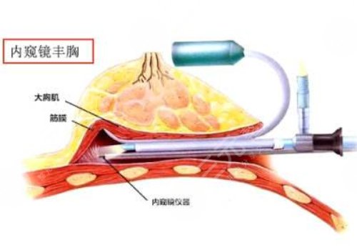 上海九院何金光隆胸多少钱？价格表+技术简介+隆胸后可爱变性感美女~