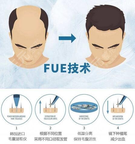 南方医科大学南方医院植发手术果图