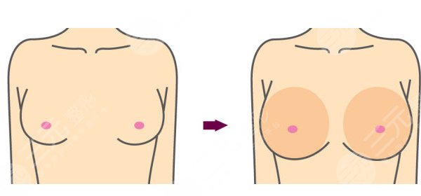 隆胸假体