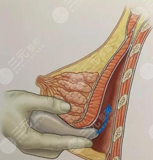 麦格假体隆胸真实感受记录