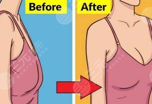 北医三院隆胸手术案例反馈