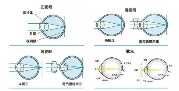 广东省人民医院飞秒激光近视手术介绍