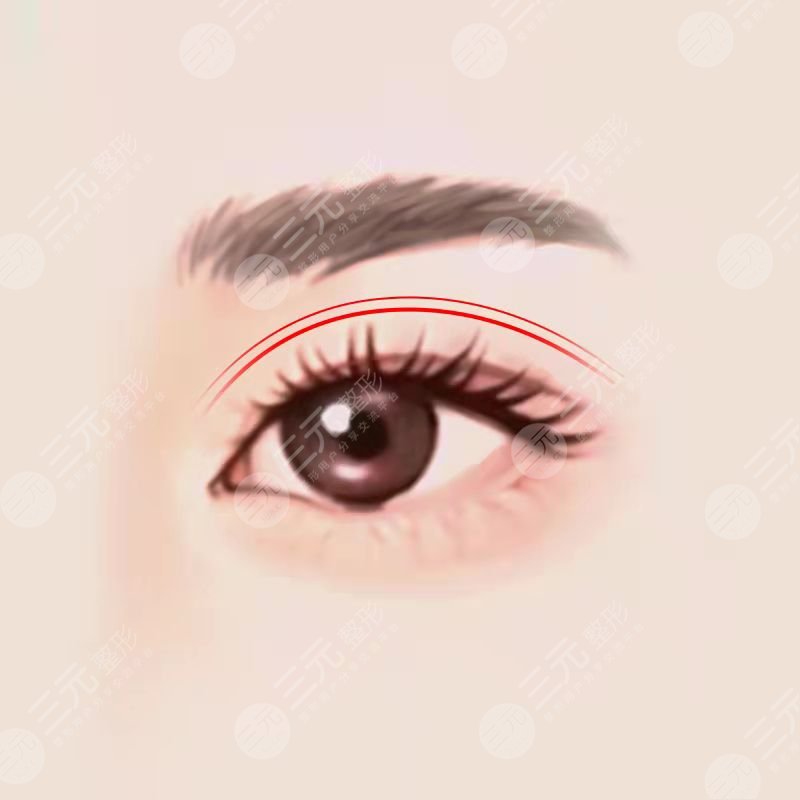 双眼皮整形和开眼角是什么意思