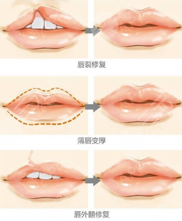 嘴唇修复手术一般多少钱