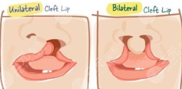 兔唇手术