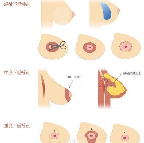 上海九院整形外科隆胸整形项目科普