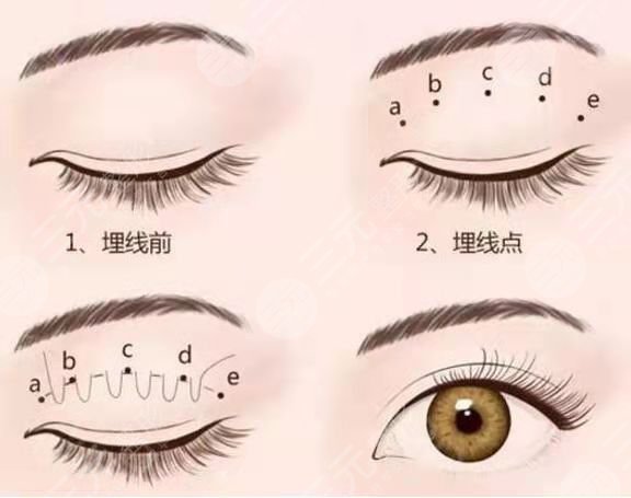厦门第一医院双眼皮案例图