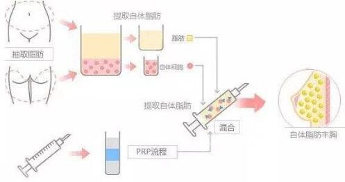 上海九院自体脂肪隆胸技术科普