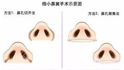 鼻整形