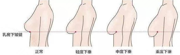 胸部下垂松弛手术上提需要多少钱?