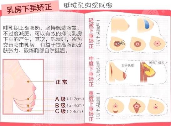 胸部下垂松弛手术上提的方法有哪些?