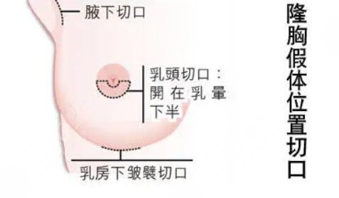 北京八大处胸部整形科普