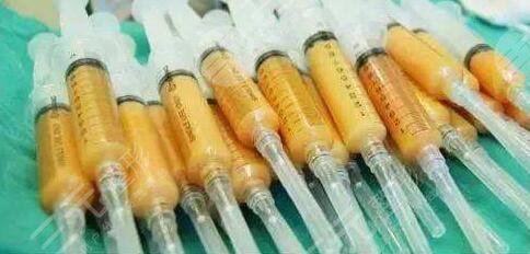 脂肪填充全脸手术的果