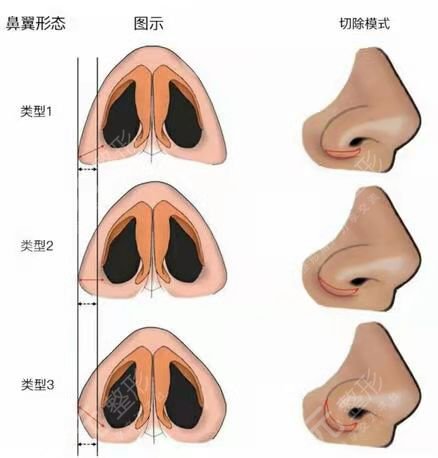 韩嘉毅做鼻子前