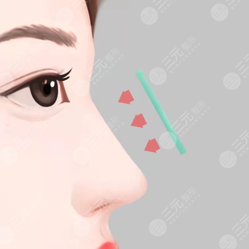 韩嘉毅做鼻子后3天
