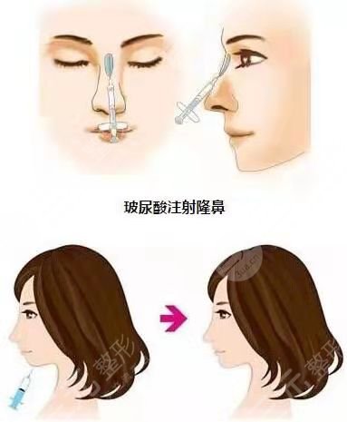 韩嘉毅做鼻子后7天