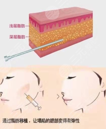 许炎龙做鼻子案例术前