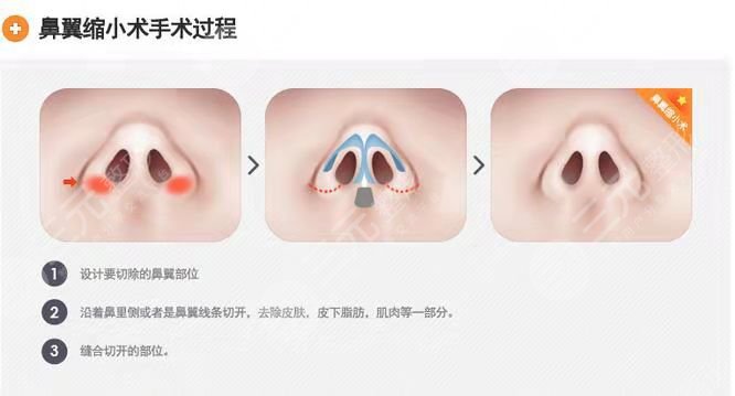许炎龙做鼻子案例术后2个月