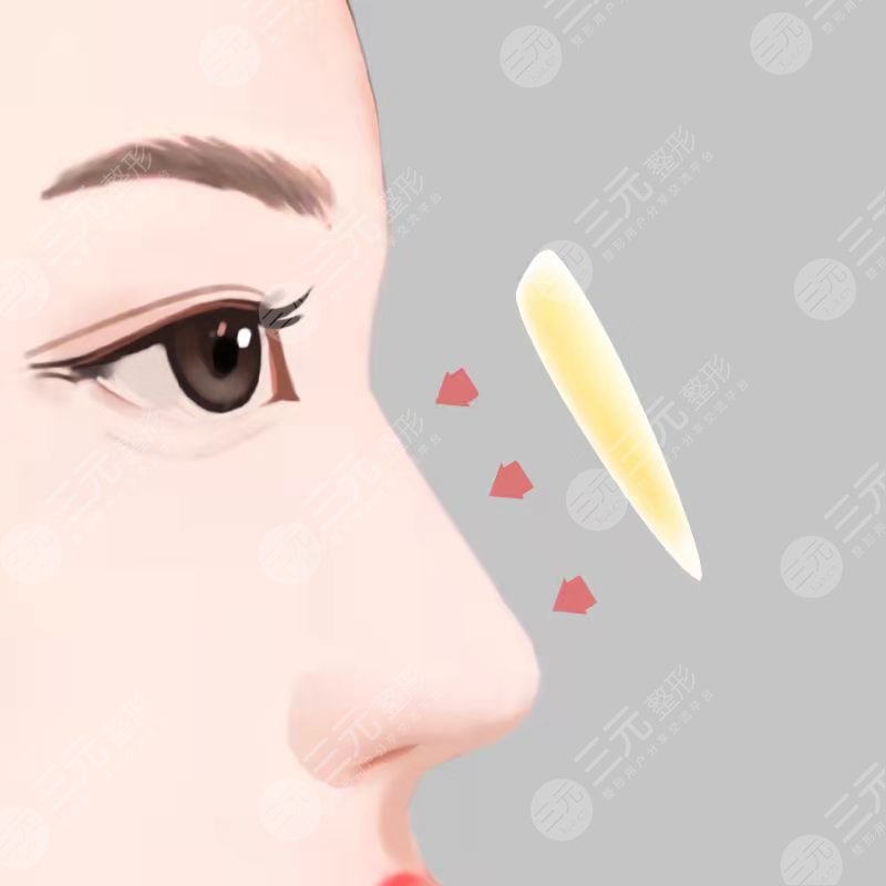 上海华美叶丽萍做鼻子后30天