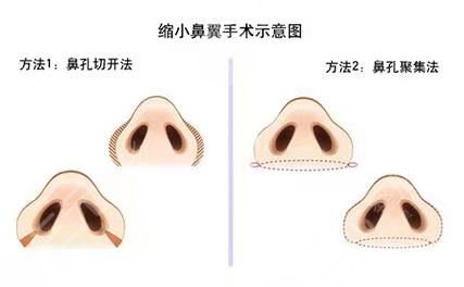 上海华美叶丽萍做鼻子后果