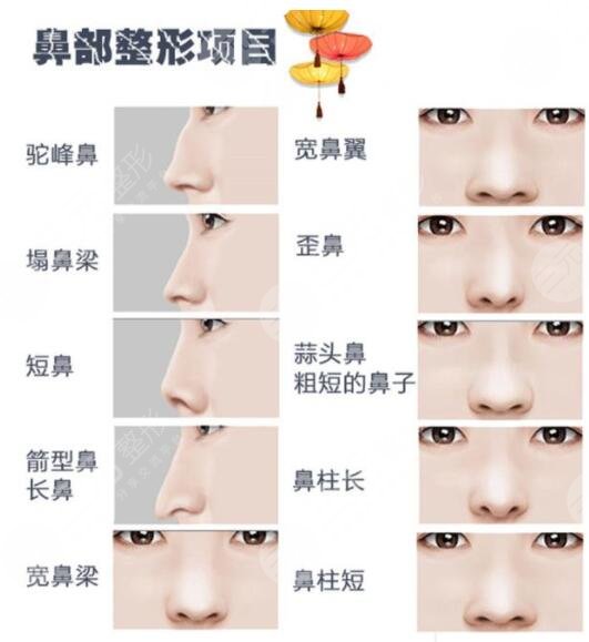 鼻部整形手术适合哪些人群