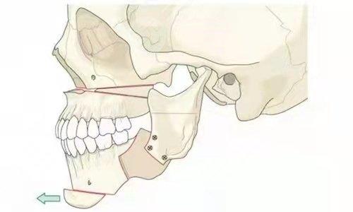 八大处滕利磨骨术前