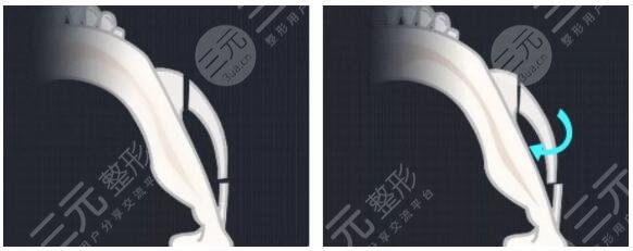 颧骨整型术适合哪些人群