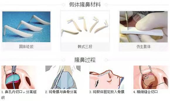 上海容妍整形医院柴云做鼻子术后5周