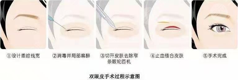 深圳市人民医院整形科双眼皮术前