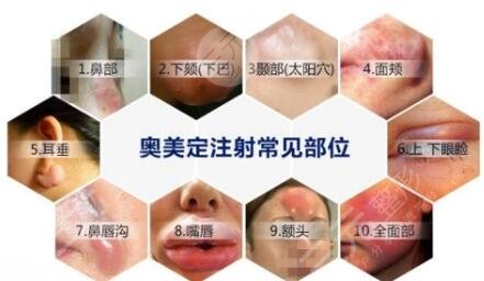 奥美定隆胸取出