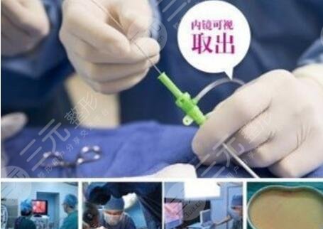 奥美定取出