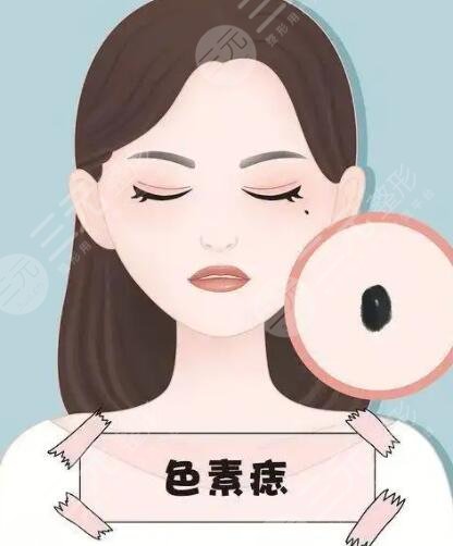 广州市第一人民医院激光去痣价格表，多少钱?