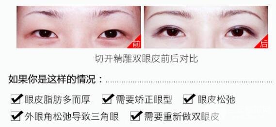 吉林省人民医院美容科双眼皮技术