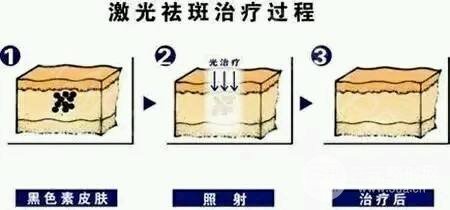 南通中医院美容科祛斑技术原理
