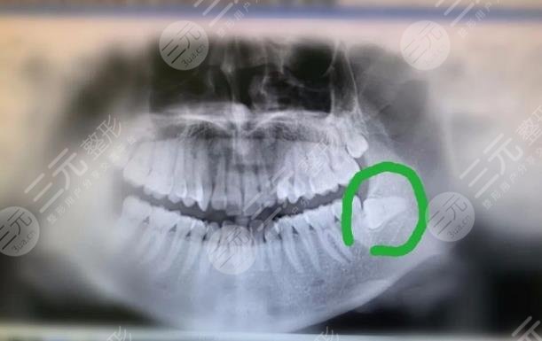 上海太平洋口腔医院拔智齿过程分享