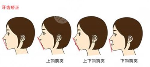 上海新华医院牙齿矫正费用