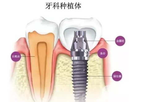 武大口腔种植牙价格表