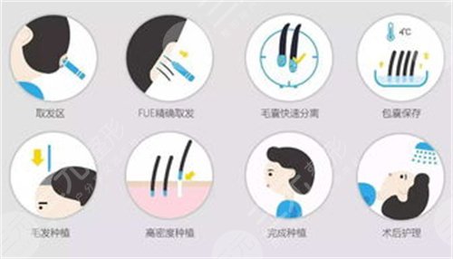 北京协和医院植发费用
