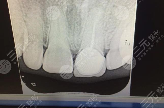 佛山爱顿口腔医院种植牙经历分享
