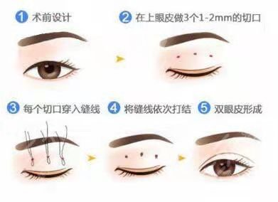 浙医二院整形双眼皮手术后