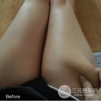 吸脂案例