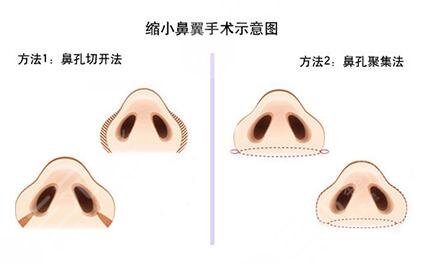 陆军总院整形美容科做双眼皮案例图