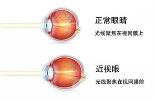 广州近视手术多少钱？2023价格表提前预览！